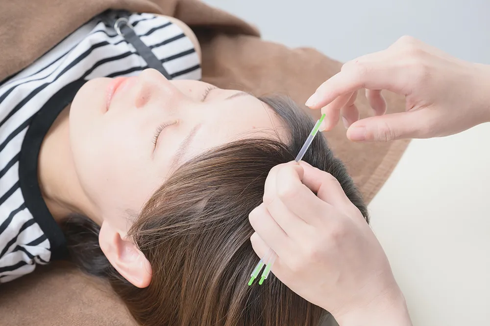 額に鍼灸の施術を受ける女性