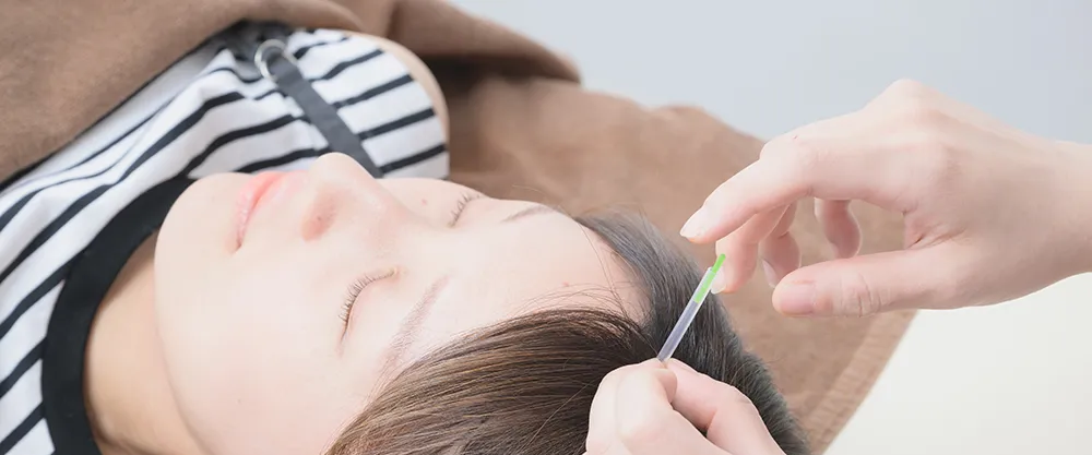 額に鍼灸の施術を受ける女性